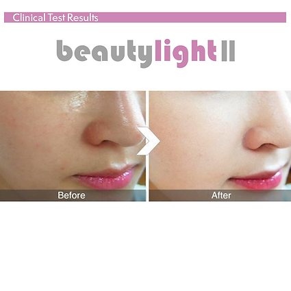 Beautylight II Photo Dynamic Thermo Therapy