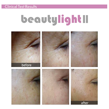 Beautylight II Photo Dynamic Thermo Therapy